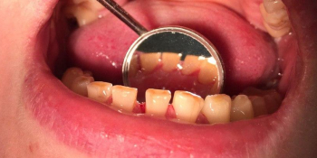 Профессиональная гигиена полости рта, результат до и после чистки фото после лечения