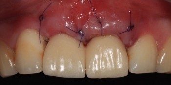 Имплантация Дентиум и установка временных коронок на передние зубы фото после лечения
