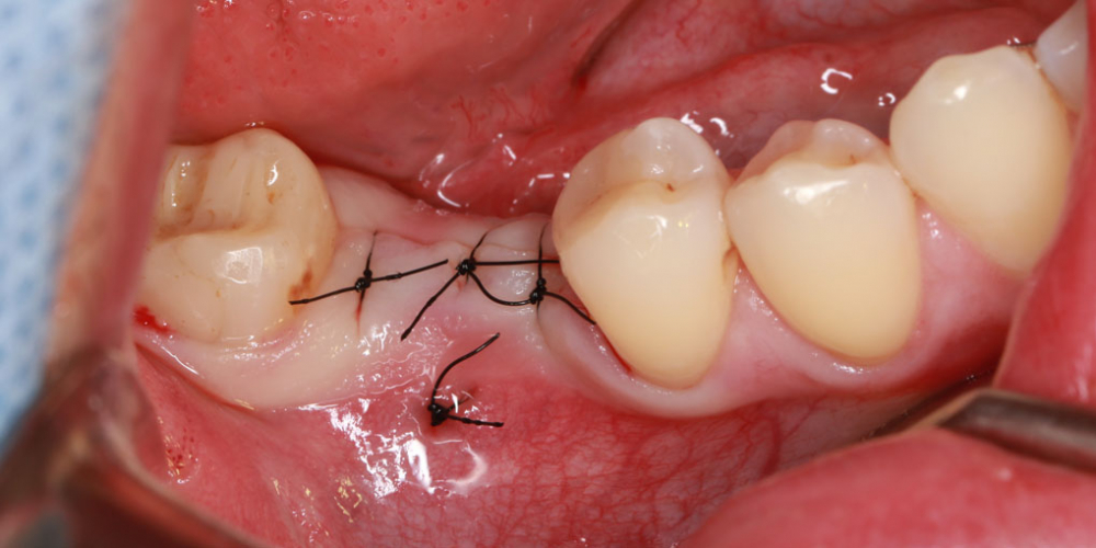  Восстановление жевательного зуба имплантатом Osstem + коронка