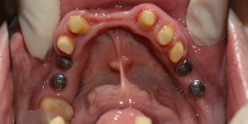 Восстановление отсутствующих зубов, эстетики и функции жевания МК коронками фото до лечения