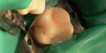 Жалобы на застревание пищи между зубами, боли от сладкого фото после лечения