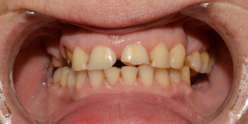 Установка 4 имплантатов для восстановления отсутствующих зубов фото до лечения