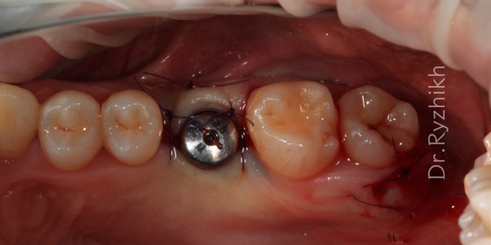 Фото сразу после имплантации и наложения швов. Установка имплантата Dentium + синус-лифтинг