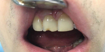 Восстановление скола зуба композиционным материалом фото до лечения