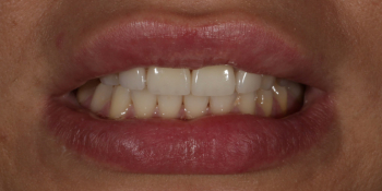 Восстановление центральных зубов верхней челюсти керамическими винирами E.max и отбеливание Zoom 3 фото после лечения