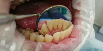 Жалобы на кровоточивость десен при чистке зубов и наличие зубных отложений фото после лечения
