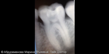 Эндодонтическое лечение зуба 3.6 при обострении хронического периодонтита фото до лечения