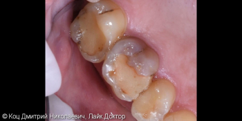 Керамическая непрямая реставрация Emax на зубы 15, 16, 17 фото до лечения