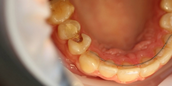 Реставрация зуба 1.4 с использованием современных композитных материалов фото до лечения
