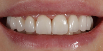 Восстановление зубов верхней челюсти керамическими винирами E.max и отбеливание Zoom3 фото после лечения