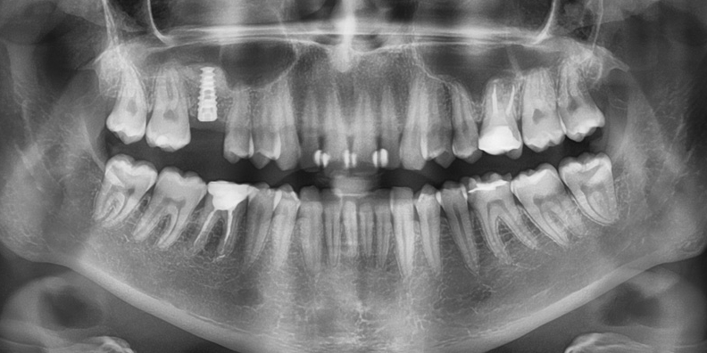 Рентген, спустя 6 месяцев после операции вживления имплантата. Установка имплантата в область отсутствующего зуба
