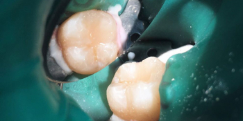 В зубе 47 была выявлена скрытая кариозная полость фото после лечения