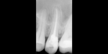 Перелечивание корня зуба фото после лечения