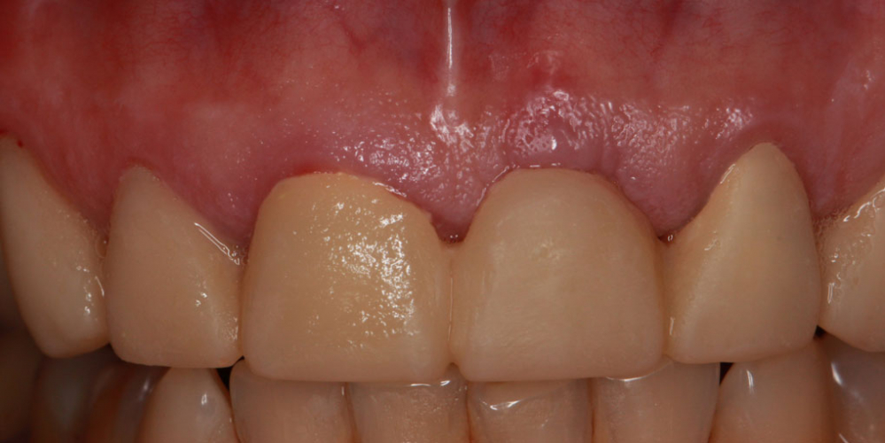  Восстановление передних зубов верхней челюсти