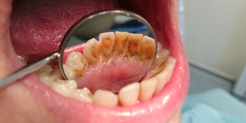 Жалобы на кровоточивость десен при чистке зубов и наличие зубных отложений фото до лечения