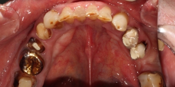 Протезирование жевательных зубов металлокерамическими коронками фото до лечения