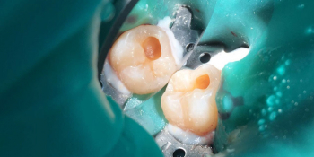 В зубе 47 была выявлена скрытая кариозная полость фото до лечения