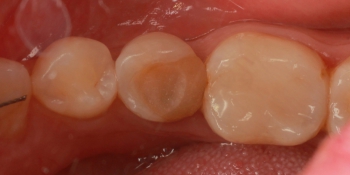 Замена пломбы 45 зуба фото до лечения