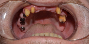 Восстановление зубов ВЧ с использованием имплантатов и мостовидных протезов на своих зубах фото до лечения