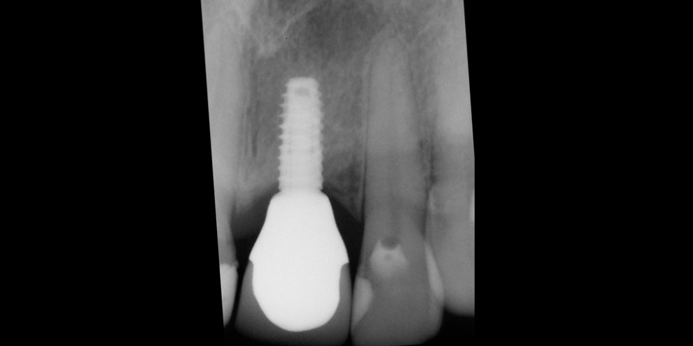  Восстановление зуба с помощью вживления имплантата и коронки