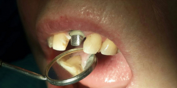 Жалоба на скол коронковой части переднего зуба в результате травмы фото до лечения