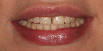 Восстановление центральных зубов верхней челюсти керамическими винирами E.max и отбеливание Zoom 3 фото до лечения