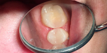 Жалобы на застревание пищи между зубами на в/ч фото после лечения