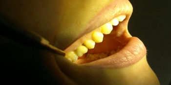 Установка имплантата в область отсутствующего зуба фото после лечения