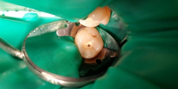 Реставрация зуба 2.6 с использованием современных композитных материалов фото до лечения
