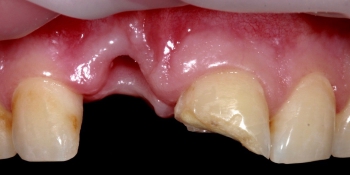 Имплантация Дентиум и установка временных коронок на передние зубы фото до лечения