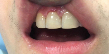 Восстановление скола зуба композиционным материалом фото после лечения