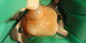 Жалобы на застревание пищи между зубами, боли от сладкого фото до лечения