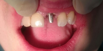Жалоба на выпадение старой коронки центрального зуба фото до лечения