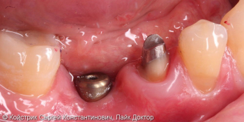 Установка 1 имплантата и восстановление разрушенного соседнего зуба вкладкой и коронкой фото до лечения