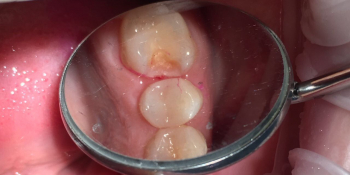 Жалобы на застревание пищи между зубами на в/ч фото до лечения