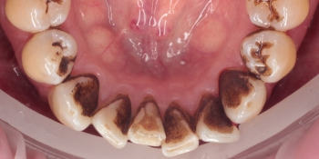 Снятие твердых зубных отложений (зубного камня) ультразвуком фото до лечения