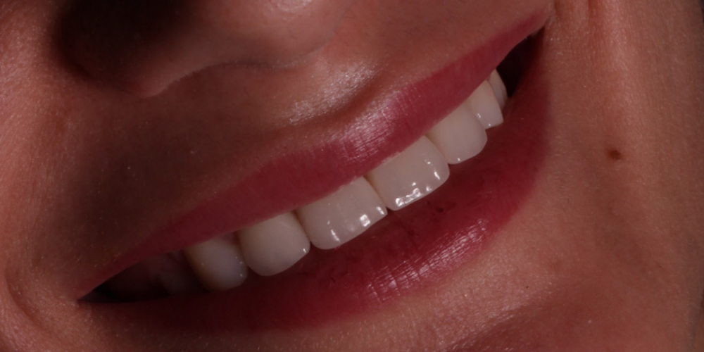 Улыбка. Восстановление зубов верхней челюсти керамическими винирами E.max