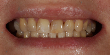 Восстановление зубов верхней челюсти керамическими винирами E.max и отбеливание Zoom3 фото до лечения