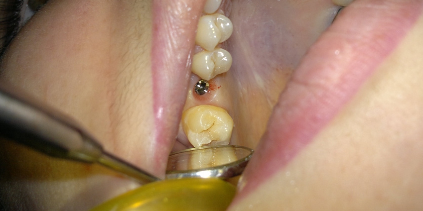  Установка имплантата в область отсутствующего зуба