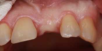 Восстановление зуба с помощью вживления имплантата и коронки фото до лечения