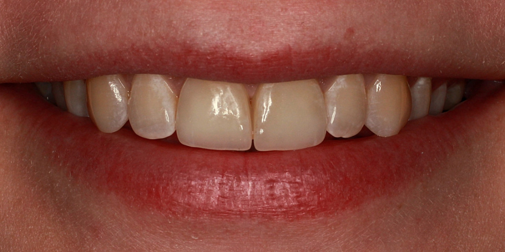  Цельнокерамические виниры E-max на передние зубы