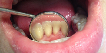 Жалобы на наличие зубных отложений и кровоточивость десен фото после лечения
